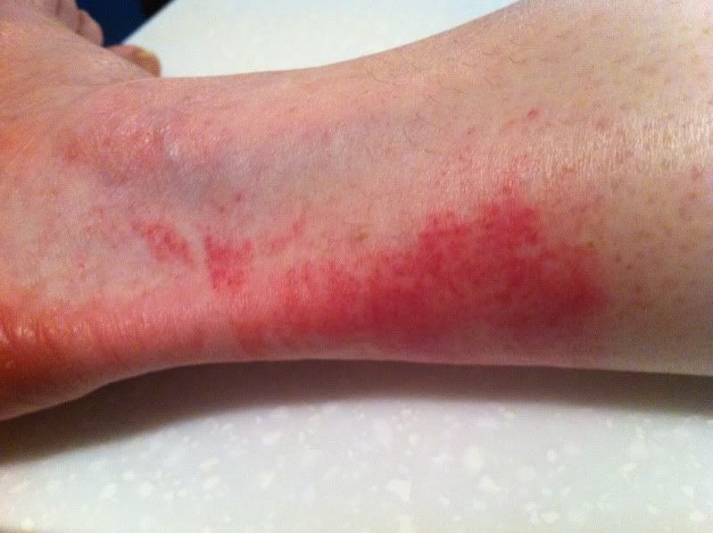 Bad rash on ankles and feet after snorkeling in St. John. St. John