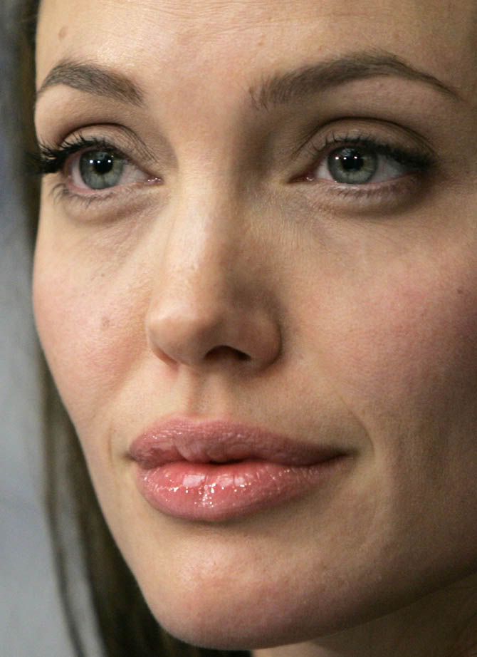 Angelina Jolie has anorexia,