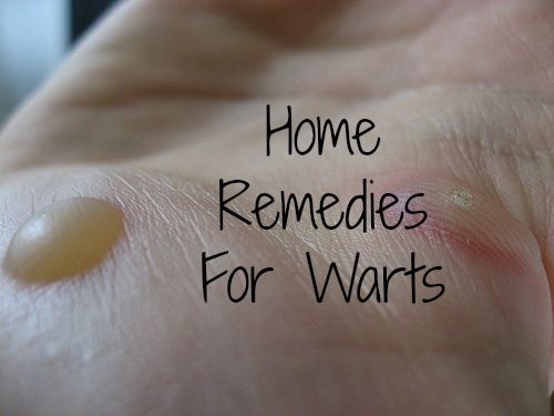 How to Get Rid of Warts Naturally | Everything Pretty