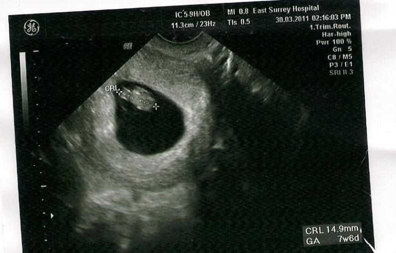 What do you think about my scans? - JustMommies Message Boards
