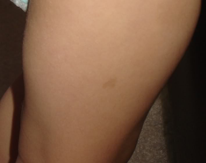 jakesbirthmark.jpg