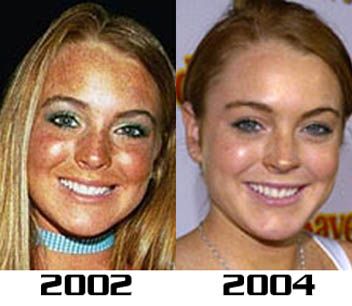 lindsay_lohan_nose2.jpg