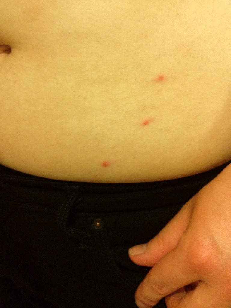 Found Bites, But No Bugs Â« Got Bed Bugs? Bedbugger Forums