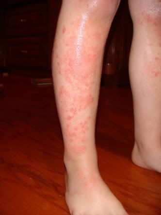 Dermatitis herpetiformis, or celiac disease rash, is an itchy rash that