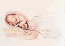 animated gif of the slaughter of childrean known as partial birth abortion