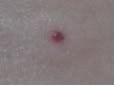 bee sting?