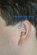 Pre-Auricular Sinus