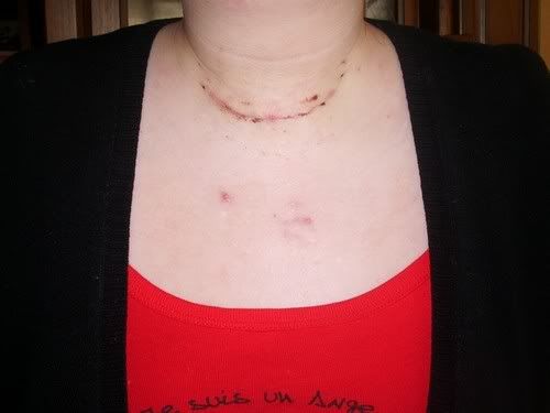 Carcinome De la Joue