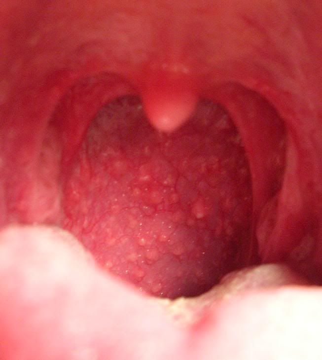 Bumps On The Back Of My Throat 49