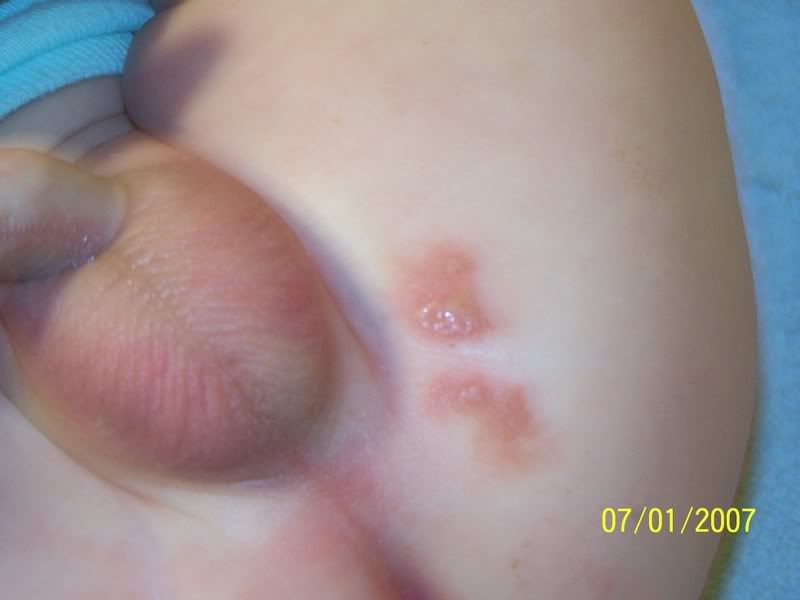 Rash On Baby S Penis 44