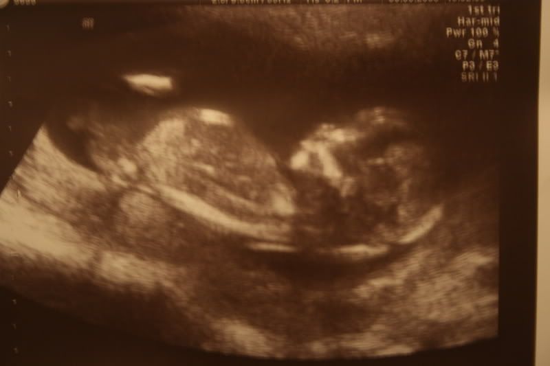 12 5 week ultrasound. 12 5 week ultrasound.