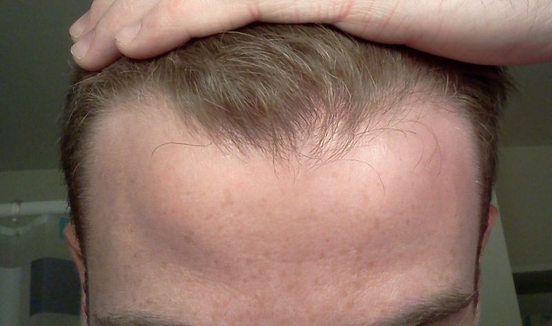 how to use minoxidil for receding hairline