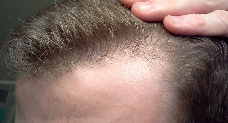should i use rogaine if my hair is thinning