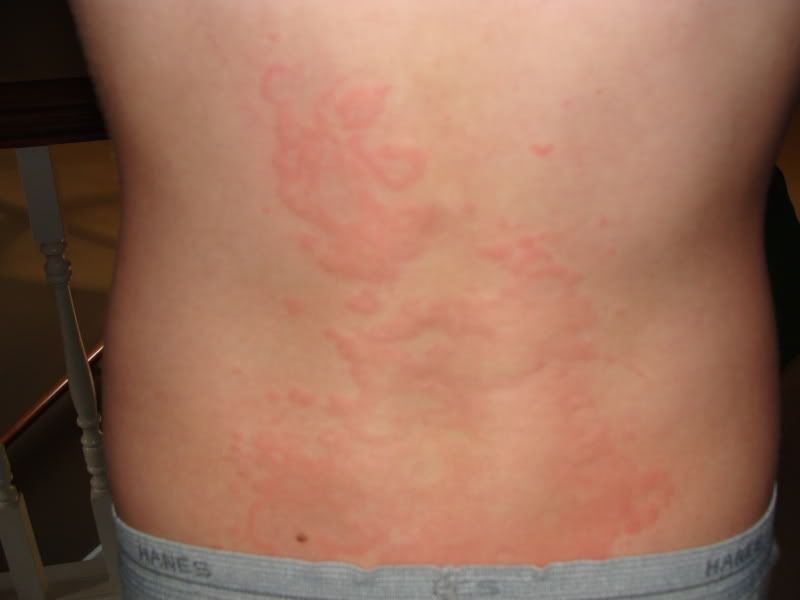 COMPLETE information about Rashes - Ashish Sharma - Hpathy.com