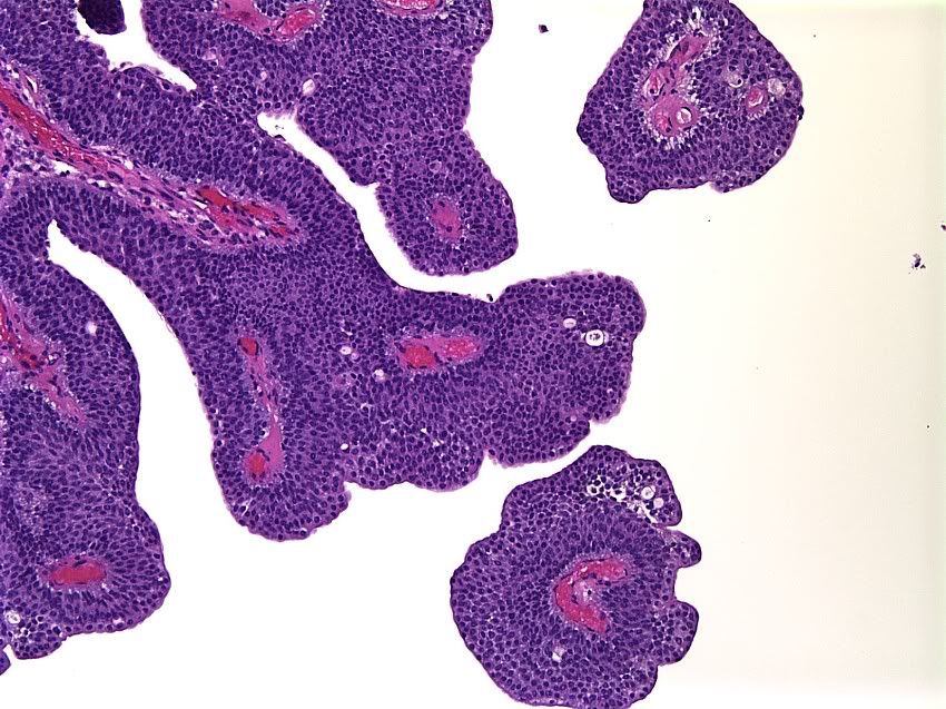 Papillary+urothelial+carcinoma