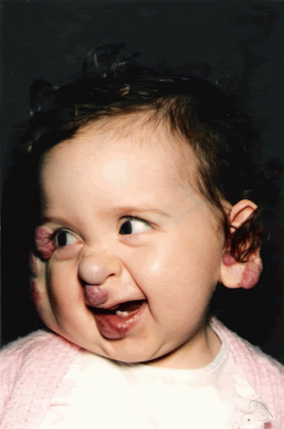 hemangioma on face. Hemangioma+birthmark