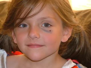 black eye hailey