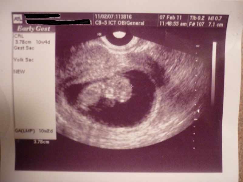 7 10 And 12 Week Ultrasounds Any Guesses In Ultrasound