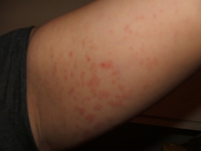 lamictal rash symptoms