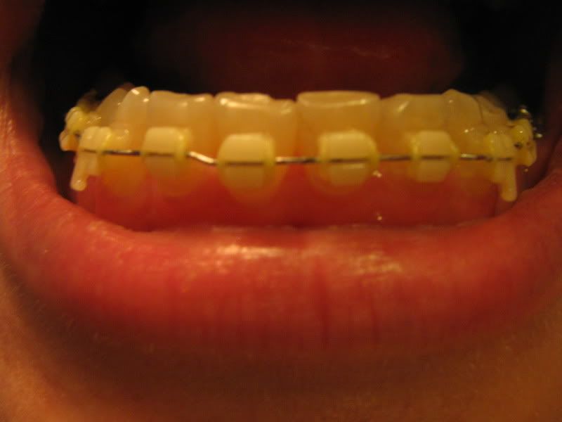 http://img.photobucket.com/albums/v254/Flowertje/ortho016.jpg