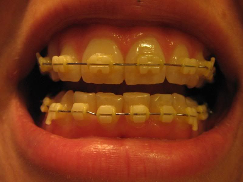 http://img.photobucket.com/albums/v254/Flowertje/ortho017.jpg