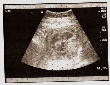 12 weeks 1 day ultrasound