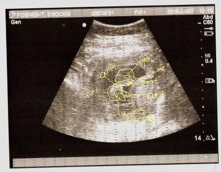 12 weeks 1 day ultrasound with explination