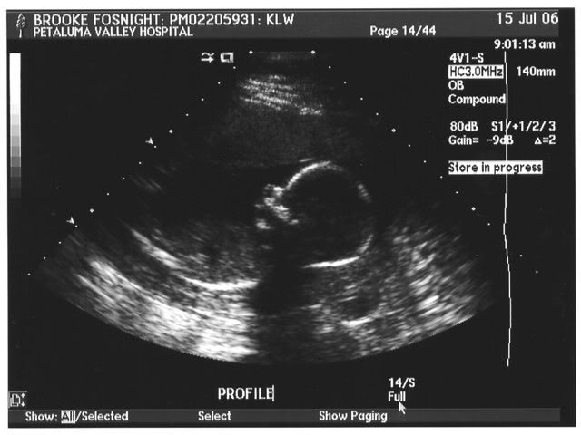17 weeks 4 days ultrasound
