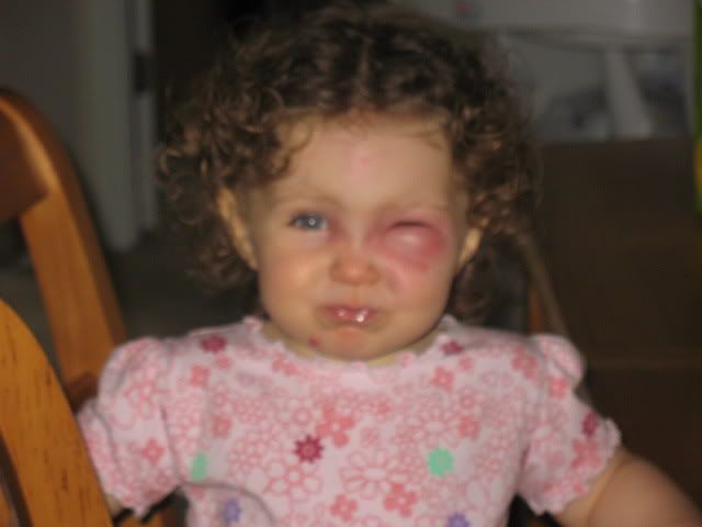 Mrsa Baby