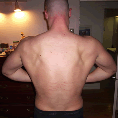 Steroid acne back