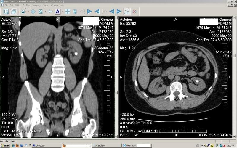 stone in kidney ct scan