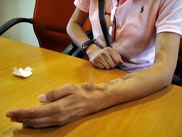 Scarring on kidney patient's forearm