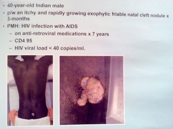 AIDS is a painful disease