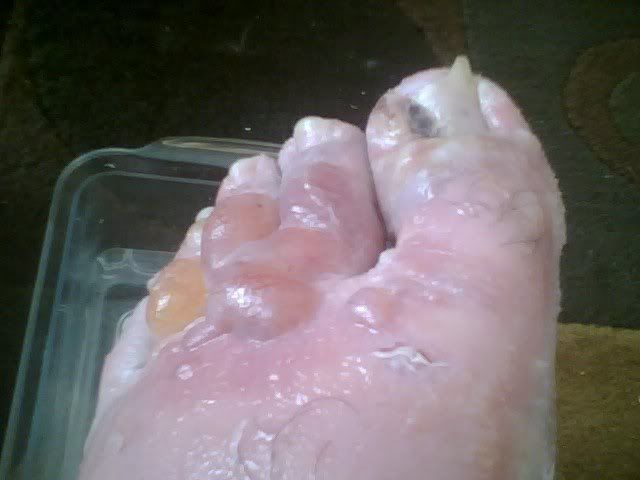 swollen toe infection