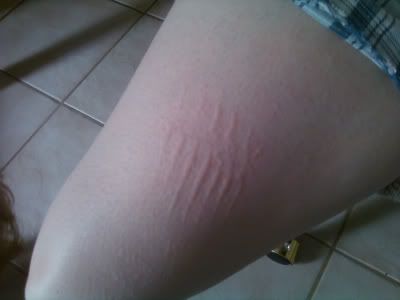 Red itchy lines on skin? | Yahoo Answers