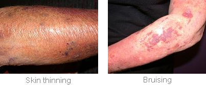 Topical corticosteroid treatments