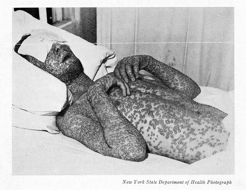 smallpox-victim.jpg