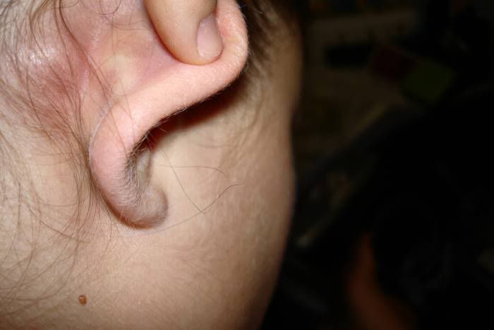 Lump Thing Behind My Ear