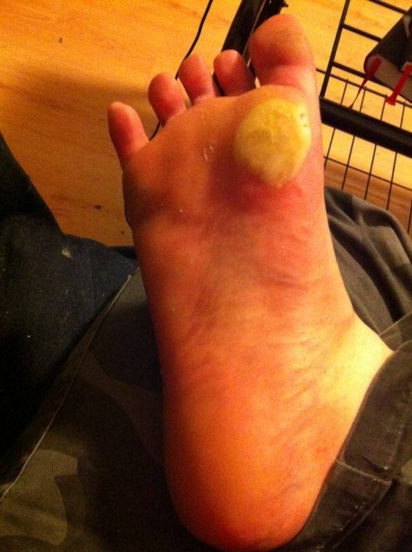 my right foot, showing huge blister on ball of foot below toe