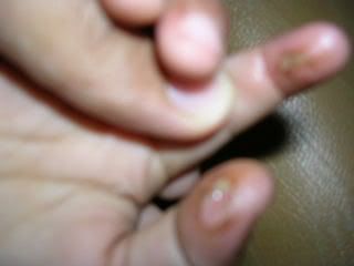 2 of 3 fingers burn by playing bungapi