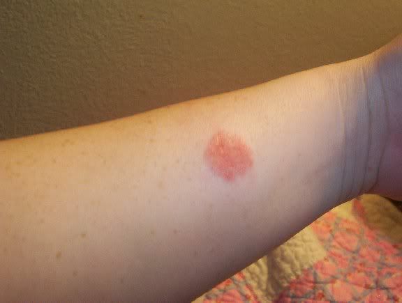 round rash on arm #11