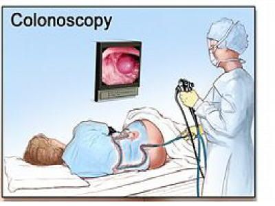 colonoscopy exam