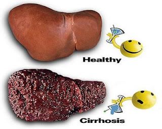 Cirrhosis-Of-The-Liver-Treatments-Stages-Causes-Symptoms.jpg