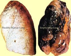 smokers-lungs-pictures-11.jpg