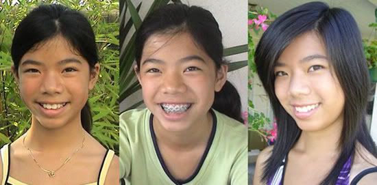 braces before and after braces photos. ~*~*efore And After Braces