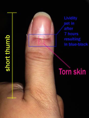 Stubbed Thumb