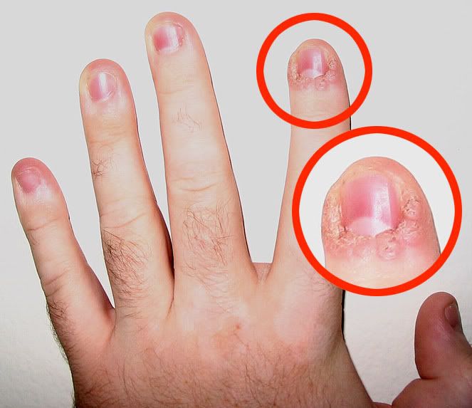 Fungal Skin Infection Between Fingers Candida Intestinala