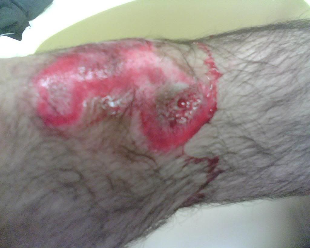 Gravel Rash