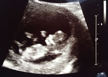 When should i get my dating scan appointment-in-Kyokyo
