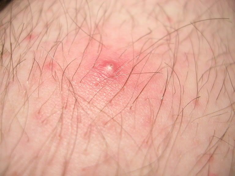 Ingrown Thigh Hair